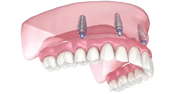 3D illustration of a full-arch dental bridge secured by four implants in the jawbone